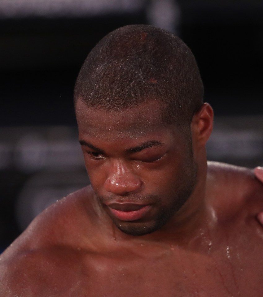 Daniel Dubois suffered a broken eye socket in his defeat to Joe Joyce