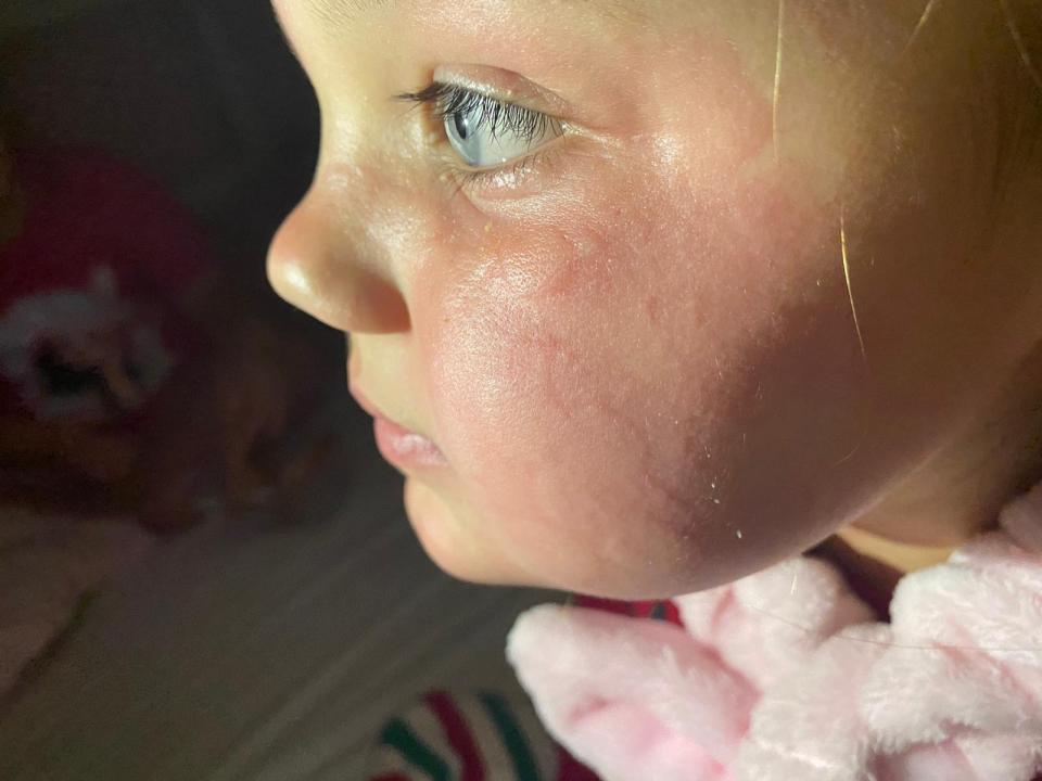 The Lacura cream caused "welts" across five-year-old Bonni Rae's face, her mum said