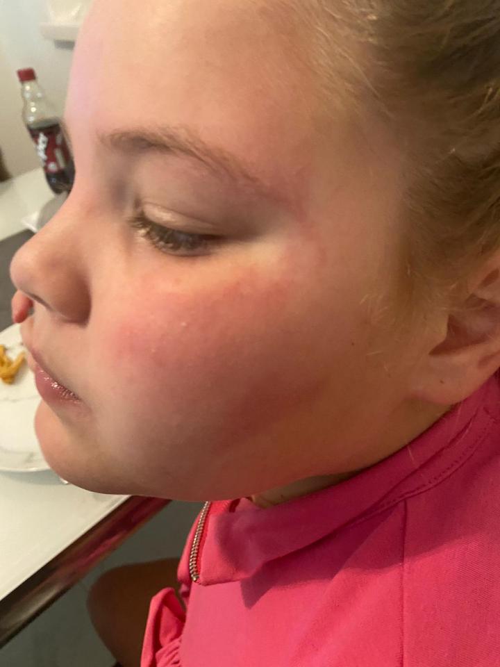Rochelle's older daughter Beau also suffered a reaction