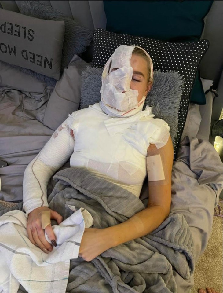 Abbie Quinnen was left with third-degree burns when a blazing wine bottle exploded in her face