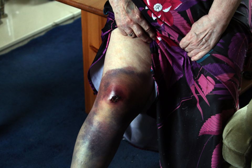 The pensioner also suffered a badly injured knee in the attack