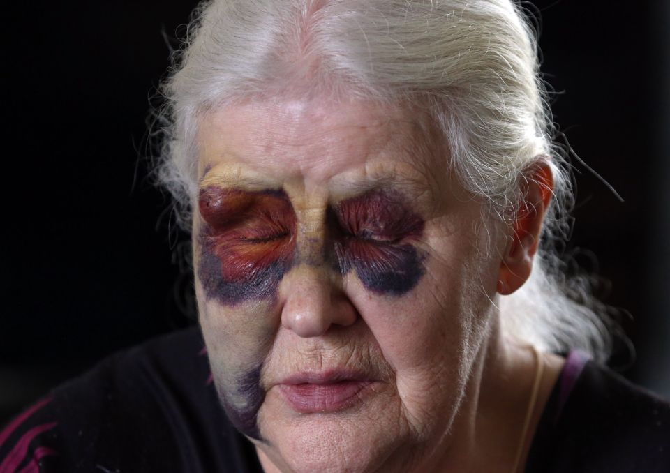 Ida suffered horrific bruising to her face in the callous attack
