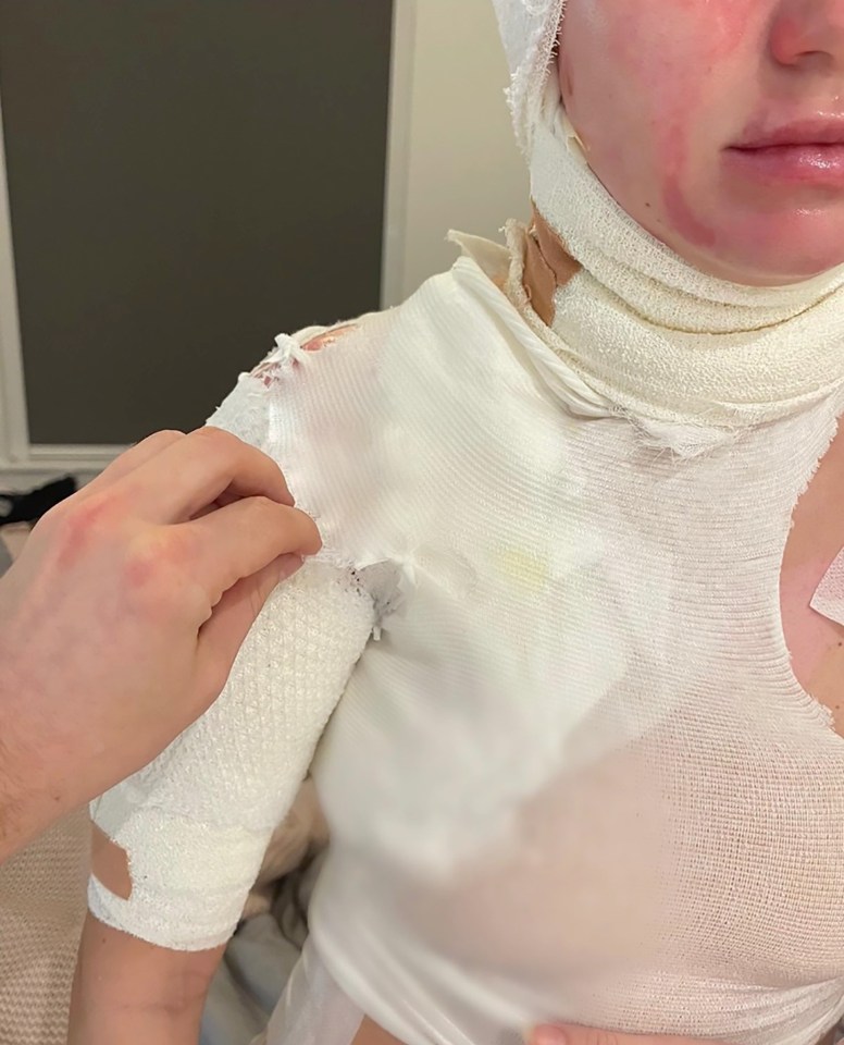 AJ says 'seconds felt like hours' as Abbie's clothes and hair caught on fire
