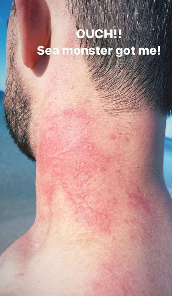 Karlson poured cola over his body to stop the stinging after the octopus attacked his neck and upper back