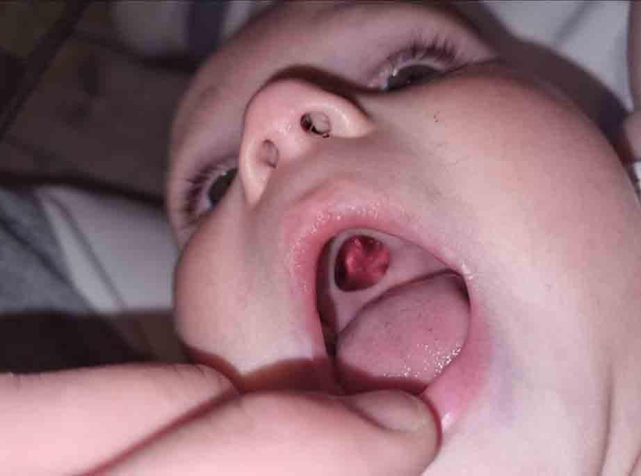 Mum Becky Stiles panicked when she saw the 'hole' in her son's mouth
