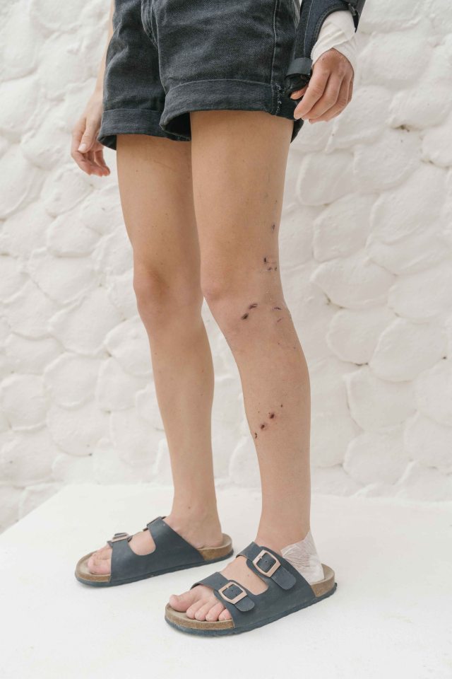 Bite marks are still clearly visible on Melissa's legs