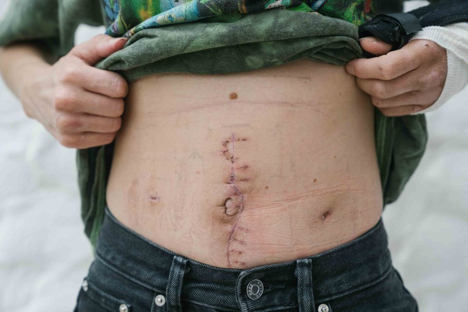 Melissa shows off the scars on her stomach following surgery after the attack