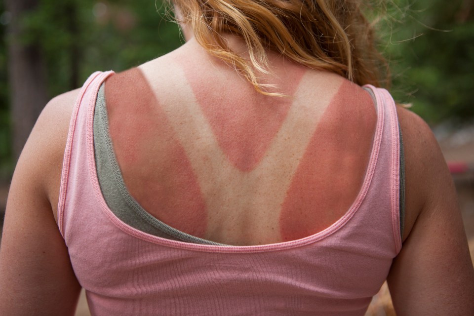 Woman's sunburned back.
