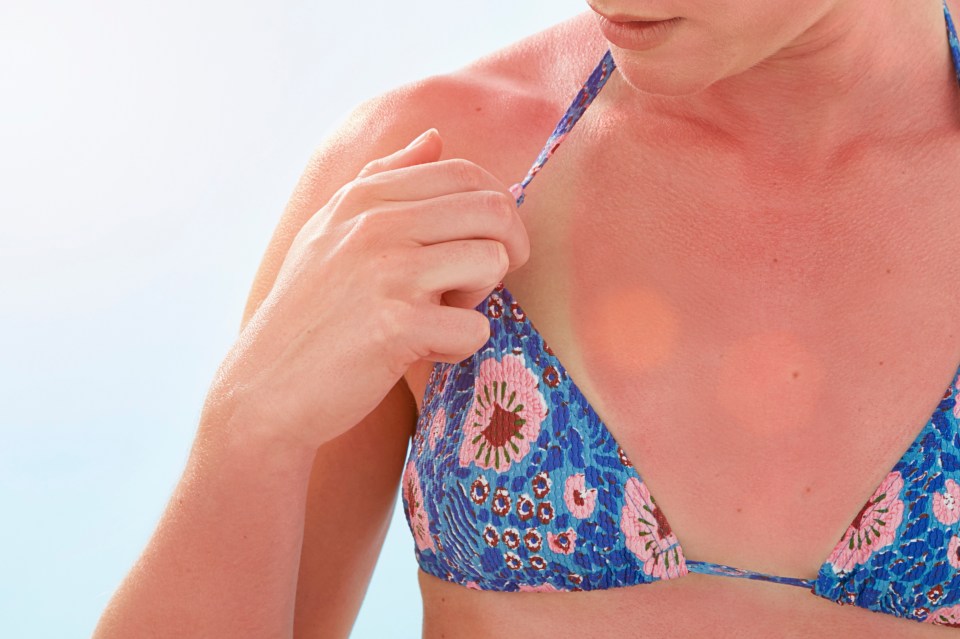 If your skin is feeling tender today due to too much sun exposure, then there are things you can do to soothe it