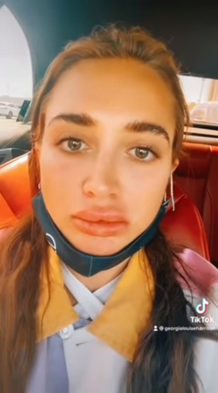 Georgia showed off her swollen lips after her first session