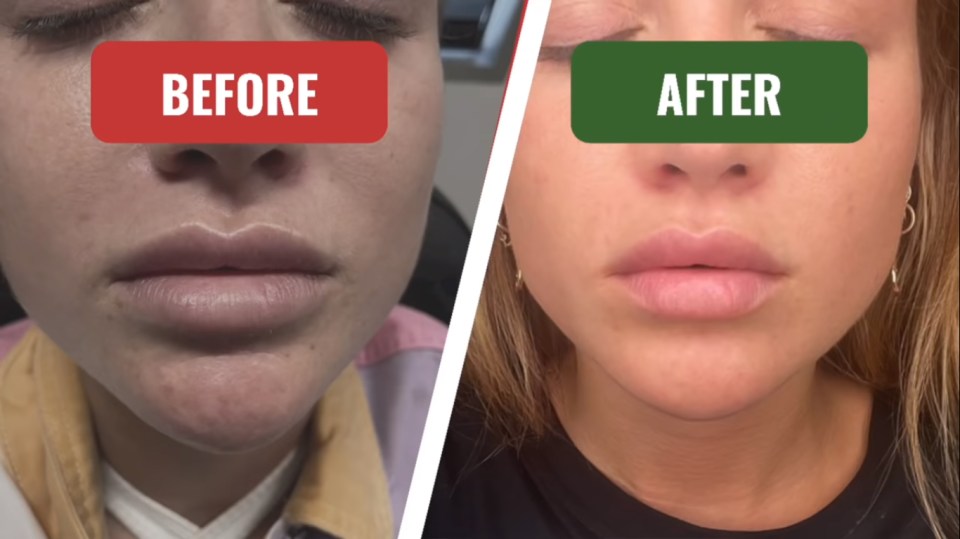 The TV star shared the 'before' and 'after' images of her lips