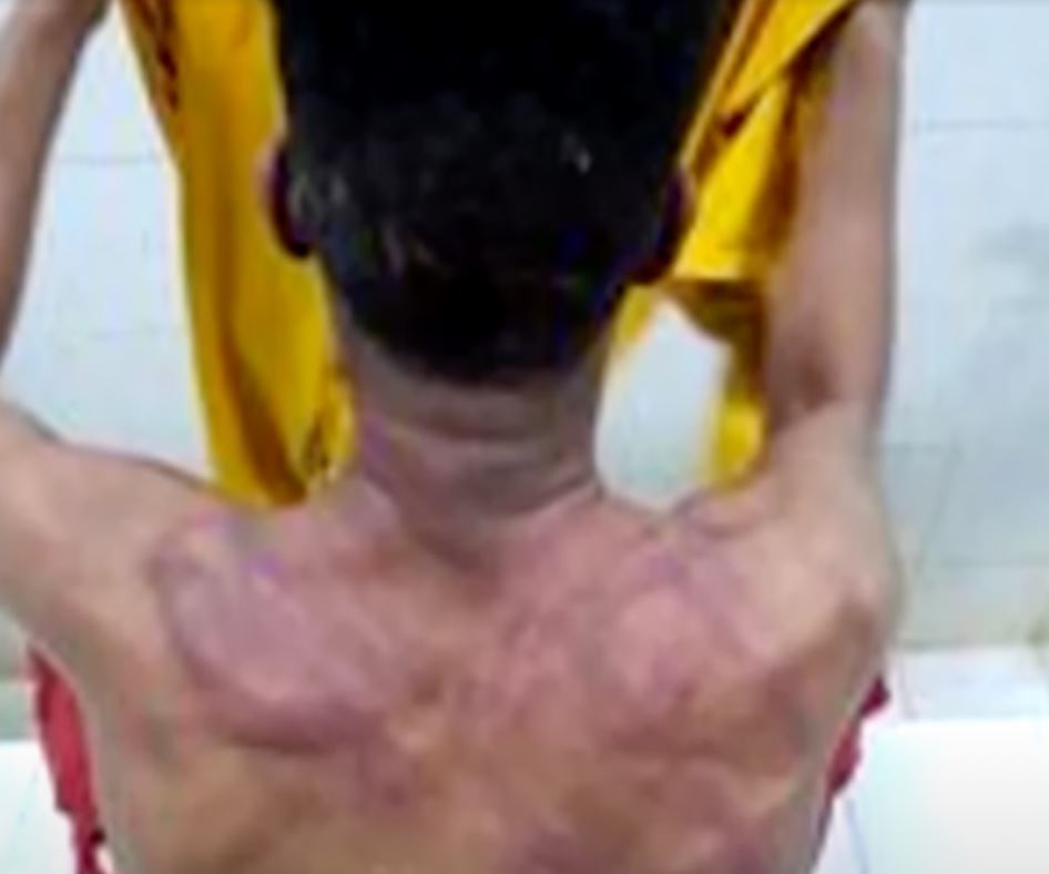 An inmate shows off his bruises and scarring from alleged beatings