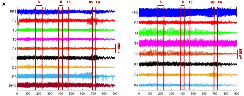 The charts above show an EEG output over a 900 second period. The chart on the left shows the left brain hemisphere and the chart on the right shows right brain hemisphere. The point of death is marked with 'CA' (cardiac arrest)