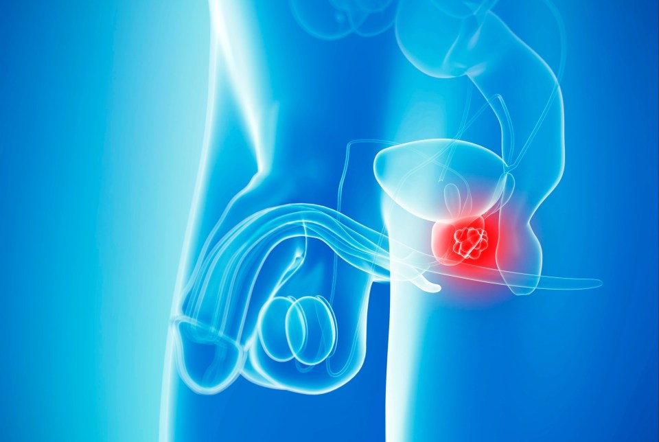 Prostate cancer is very common, and the causes are largely unknown. The prostate is a small, walnut-sized gland, that only men have (shaded in red)
