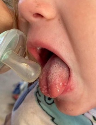 Blisters spread over the little ones' lips, tongue, and inside of the mouth