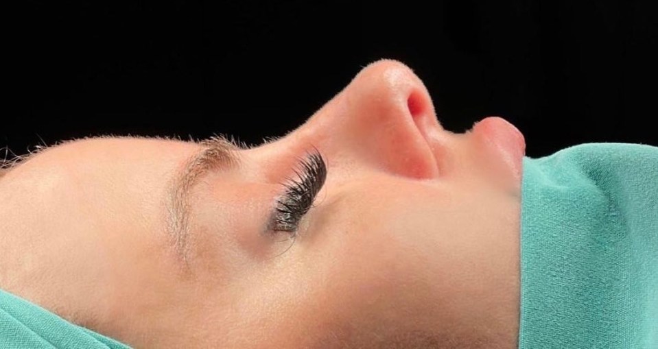 Hannah Elizabeth shared photos of her nose taken on the operating table before and after her rhinoplasty surgery