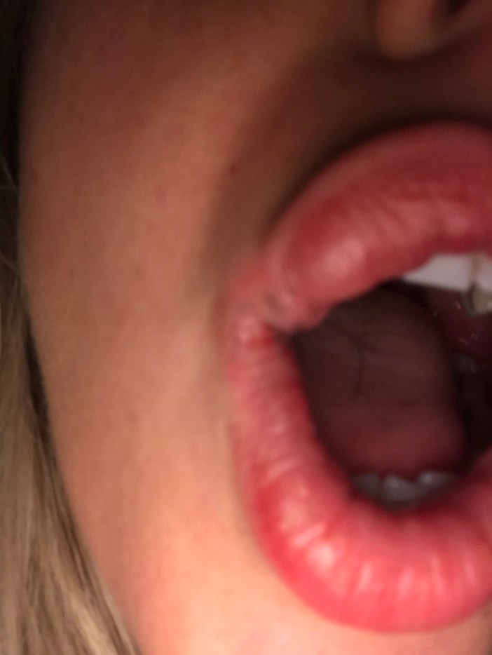 Her lip swelled up and was painful for weeks