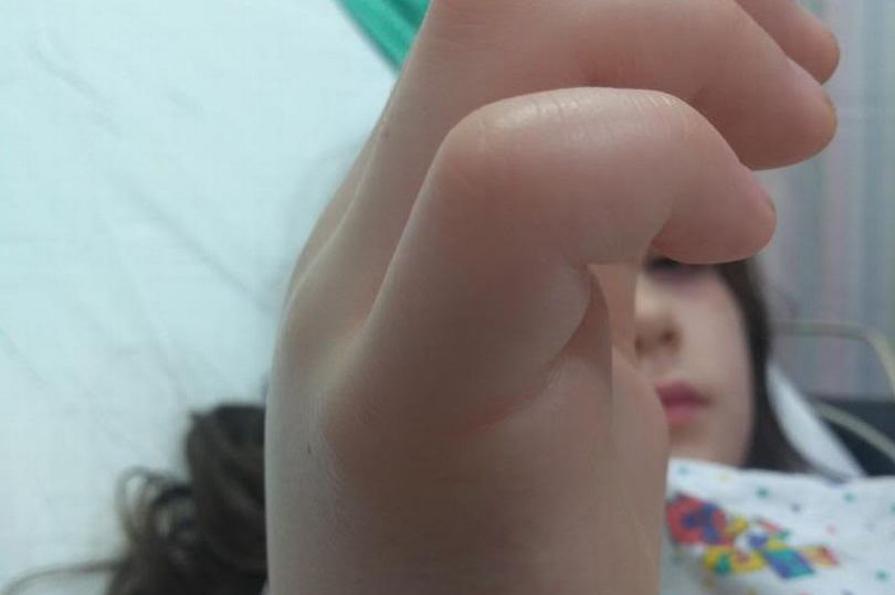 The little girls finger began to swell rapidly