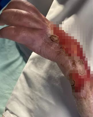 Jade, a mum-of-one, scratched her arm in 2018. It developed into an ulcerated wound which has never healed