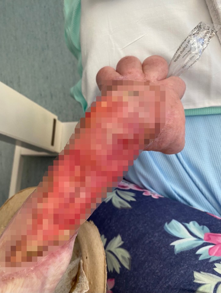 Jade said: “I’m on super strong painkillers and constantly sick because I have a nerve exposed on my wrist, we’re getting nowhere fast and the risk of getting sepsis again is so high"