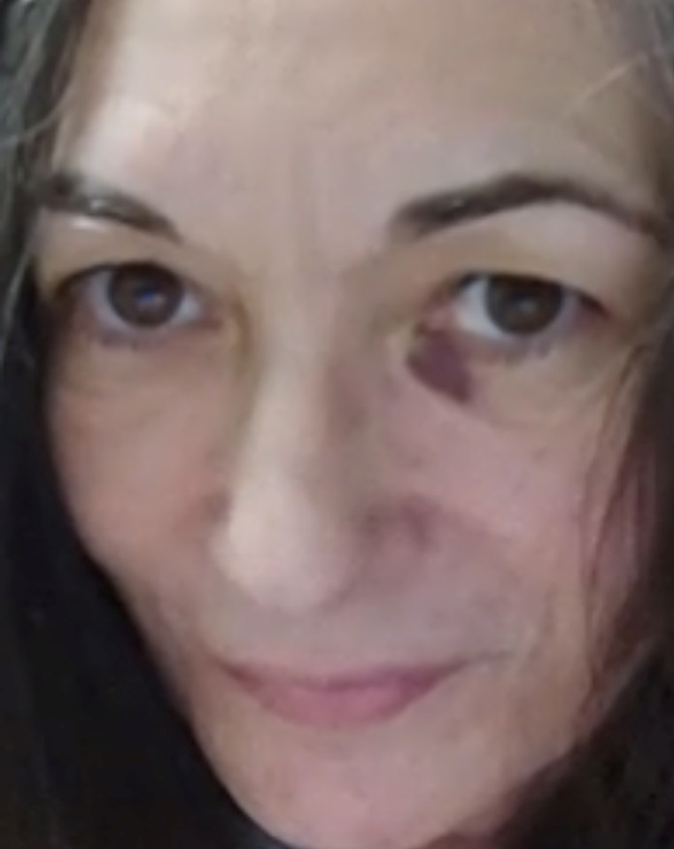 Maxwell has been pictured with an unexplained black eye as she complains of her jail conditions