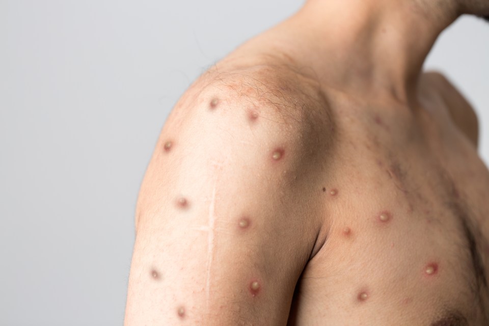 A total of 96 monkeypox cases have been confirmed across the Canary Islands
