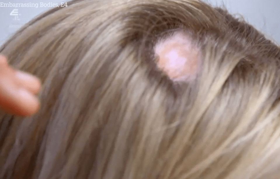 The 36-year-old was left with a giant hole in her head after developing melanoma