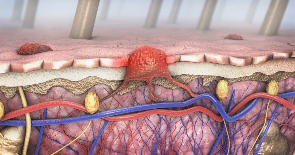 Get your moles checked if they appear larger than 6mm