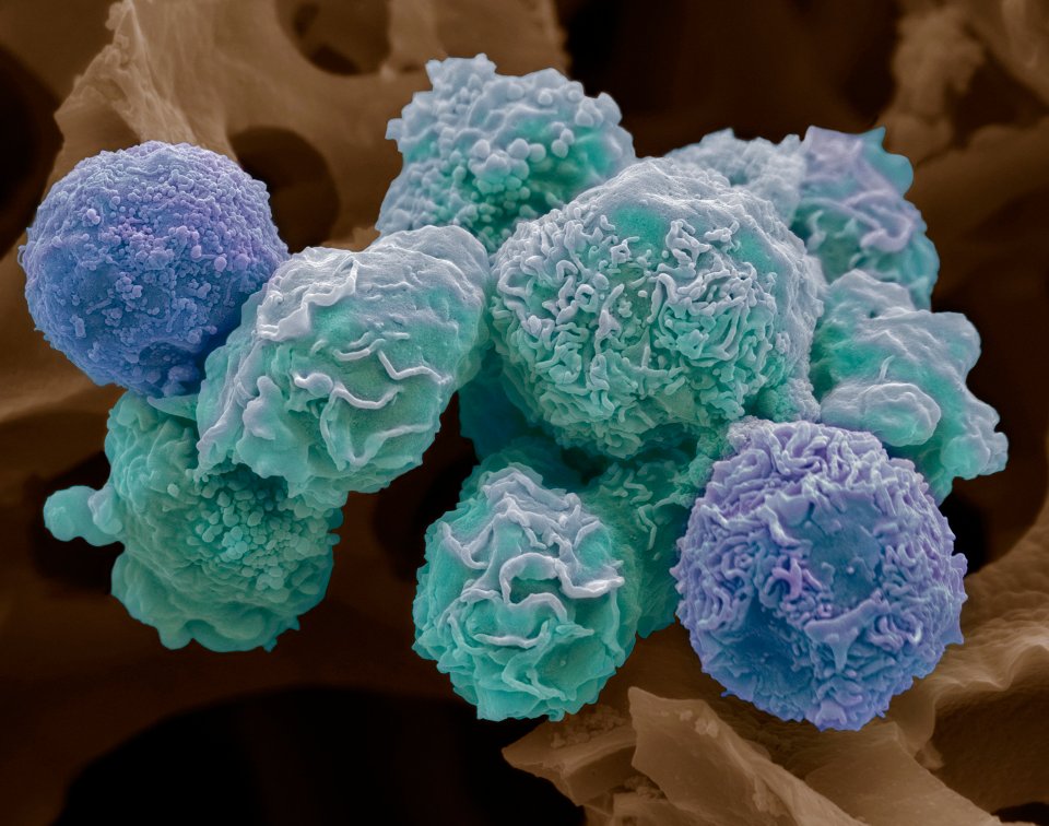 More than 52,000 men a year are diagnosed with prostate cancer