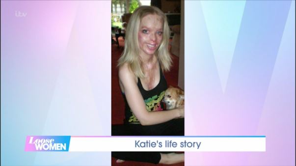Katie, 38, told how people ordered her out of shops due to her visual difference