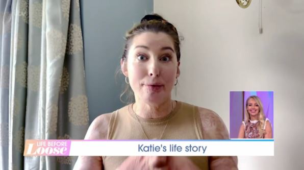Katie beamed as she spoke to a fellow burns victim who now works for her foundation