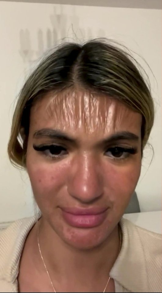 Sirin's face was so badly burnt that it looked like plastic