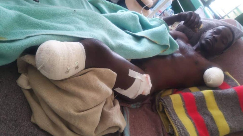 Winders had his leg and arm amputated