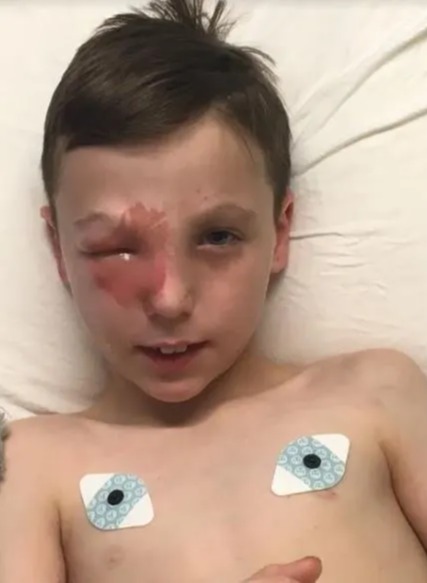 Tyler, now 16, is considering having a prosthetic eye fitted