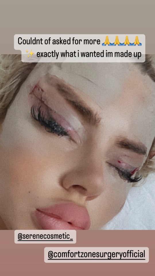 The TV star also underwent "fox eye" surgery