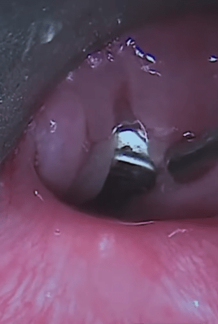 Pictured is a battery lodged in a child's food pipe Credit: Tiny Hearts Education