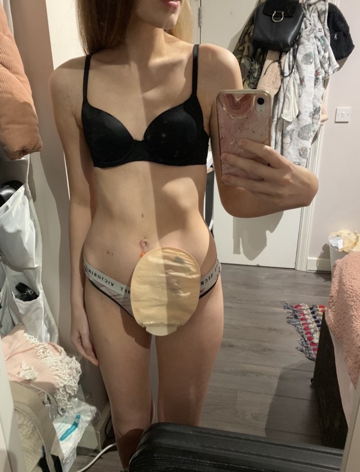 Katie plummeted to just 5st and people feared she had an eating disorder