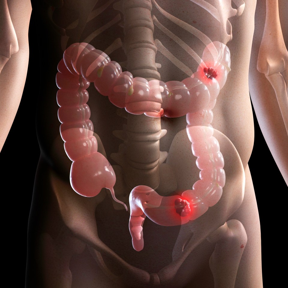 Bowel cancer’s rise is alarming. The number of cases shot up by ten per cent between 2019 and 2021, according to NHS figures