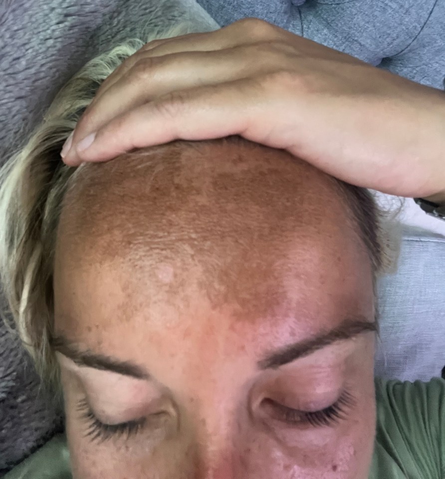 She wants people to use her experience as a warning against nasal tanning sprays