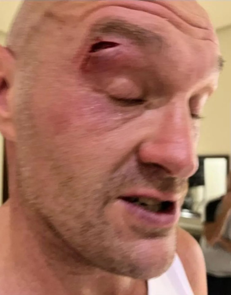 The cut that forced the fight to be postponed