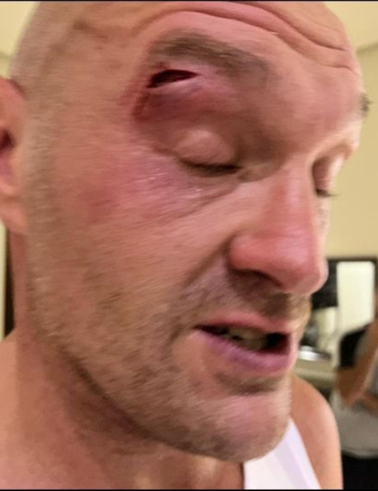 A huge cut on the brow of Fury's right eye forced the postponement of the fight