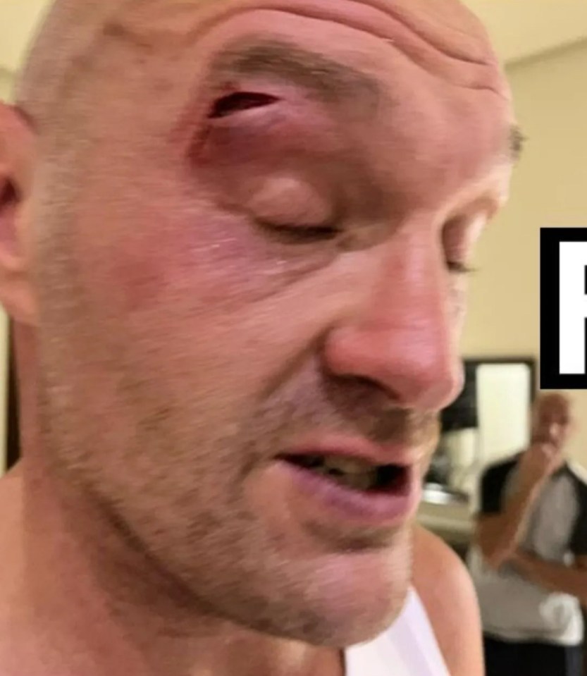 Tyson Fury's cut that postponed the fight