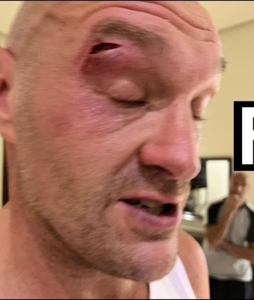 Fury was left with a huge gash above his eye that caused his bout with Oleksandr Usyk to be postponed