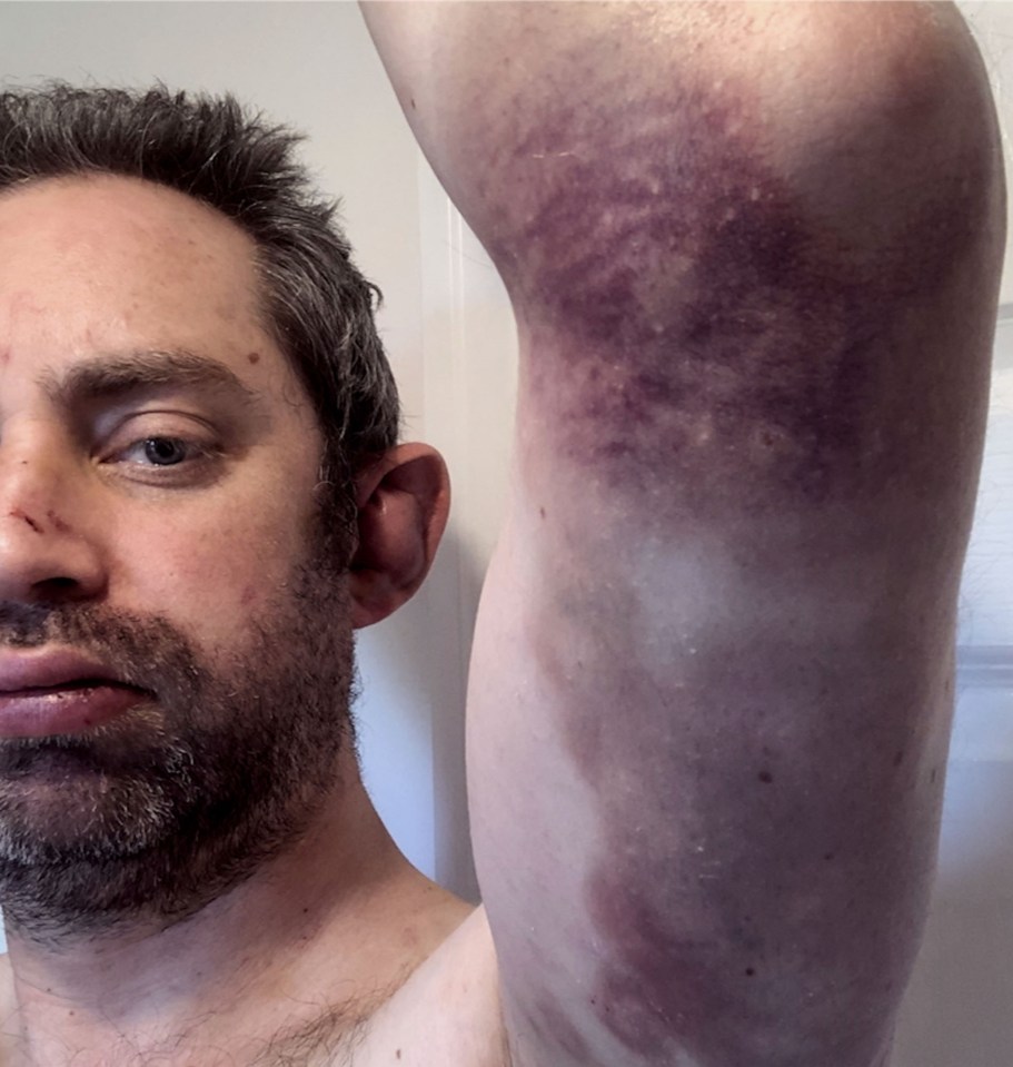 Richard and Sheree Spencer abuse case Richard Spencer - Camera footage of bruises inflicted by Sheree Spencer