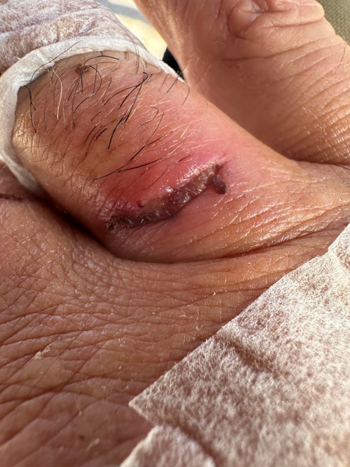 Gavin said he was very lucky to have escaped with just a few scars
