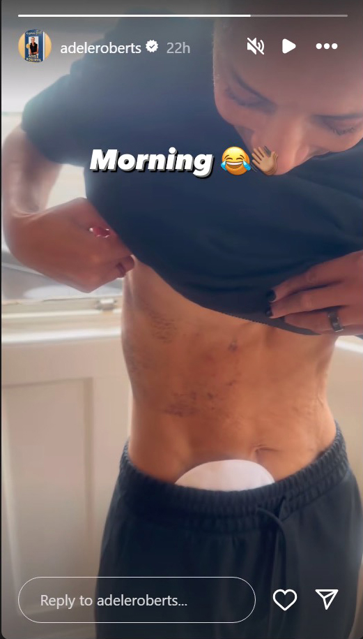 The star was left with tape marks all over her body