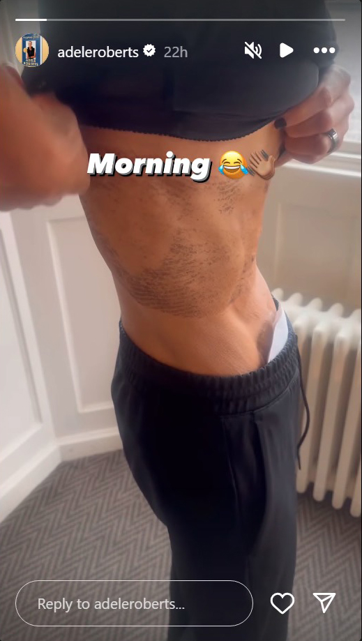 Adele Roberts showed the marks on her skin