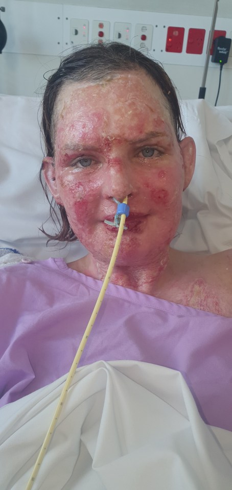 But she found herself fighting for her life after a gas fire explosion left her in a coma