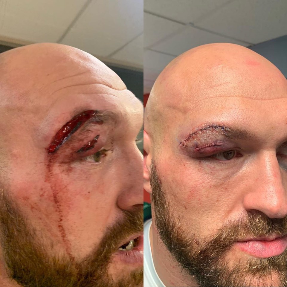 The Brit boxer needed 47 stitches in the wound