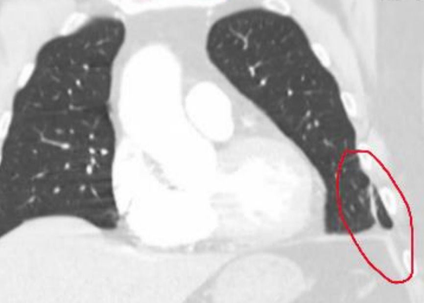 a black and white image of a person 's chest with a red circle around it .